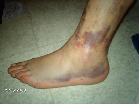 Le 5 D�cembre 2008...., voil� l'�tat du pied de Mickey, suite au match du 30-11-08